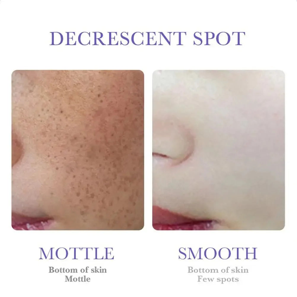 Freckle Removing Nicotinamide Face Cream