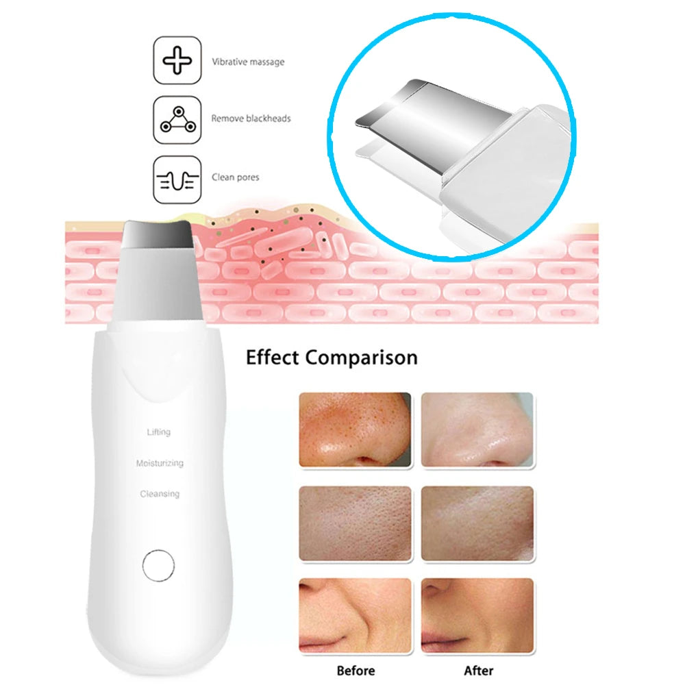 Ultrasonic Blackhead Remover & Skin Scrubber